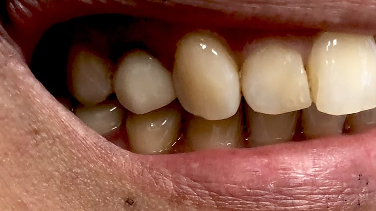 After Invisalign Benefits