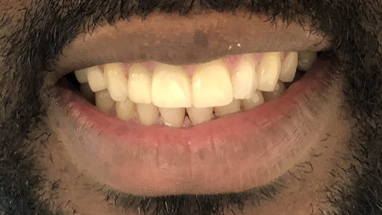 After Invisalign Benefits