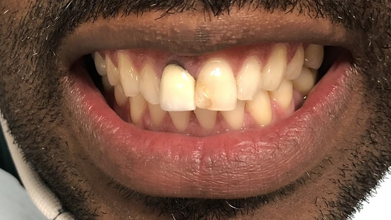 Before Life-Like Crown Benefits