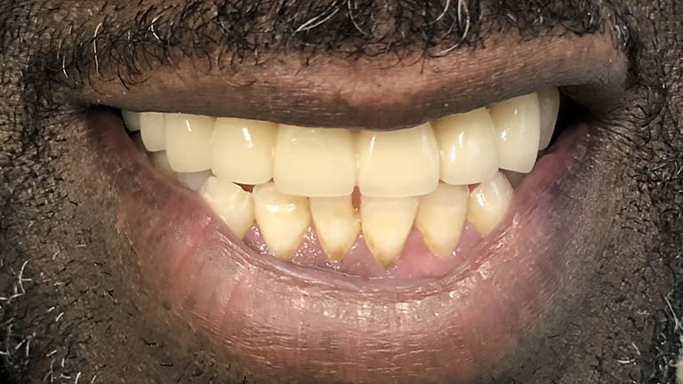 After Invisalign Benefits