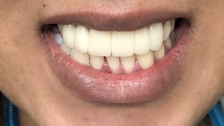 After Invisalign Benefits