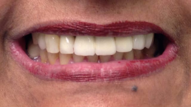 After Dental Implants Benefits