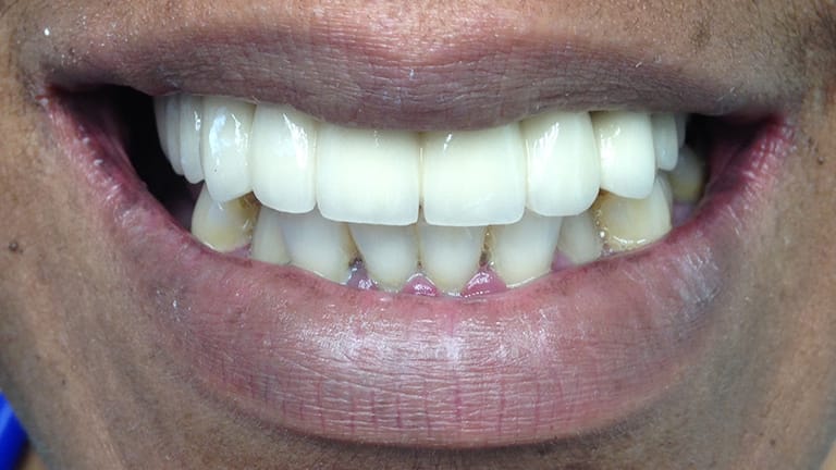 After Dental Implants Benefits