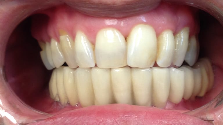 After Dental Implnats Benefits