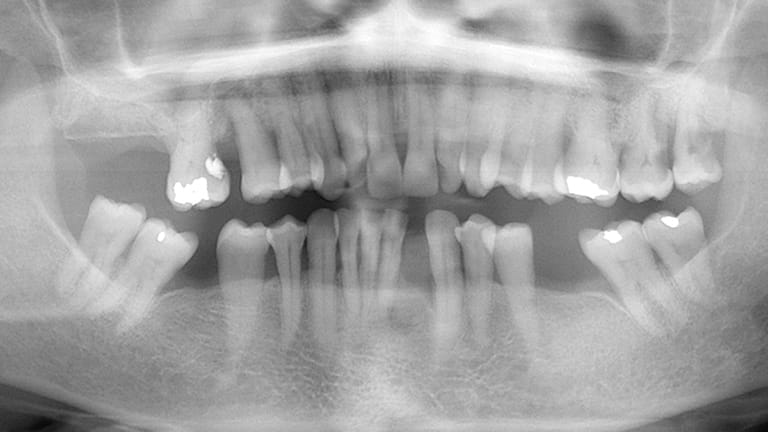 Before Dental Implant Benefits