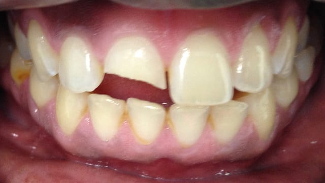 Before Life-Like Crown Benefits