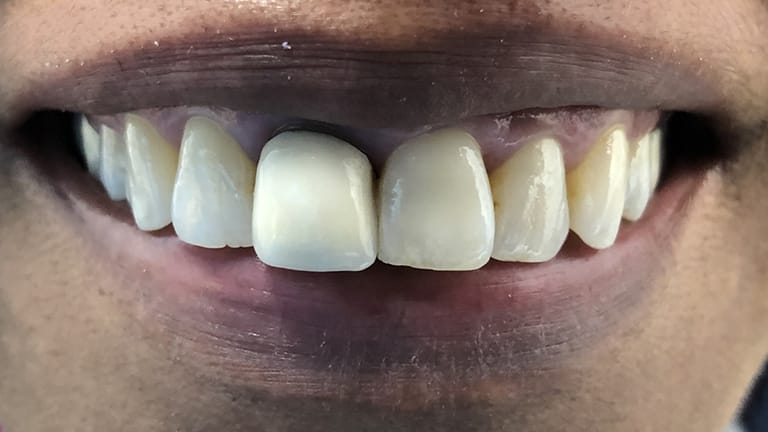 Before Crown Zirconia Benefits