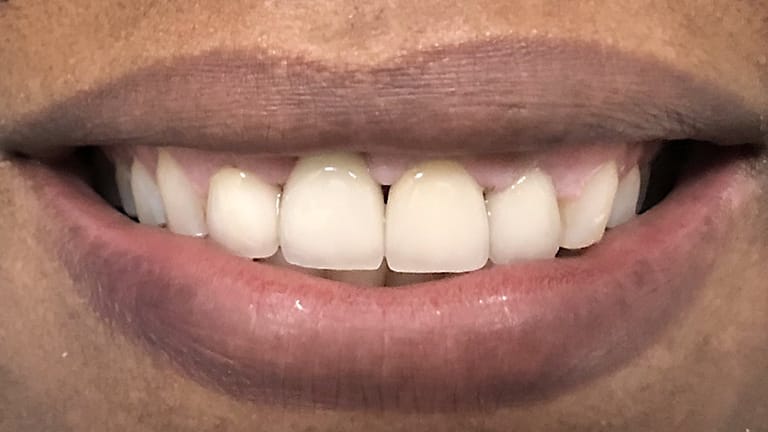 After Crown Zirconia Benefits