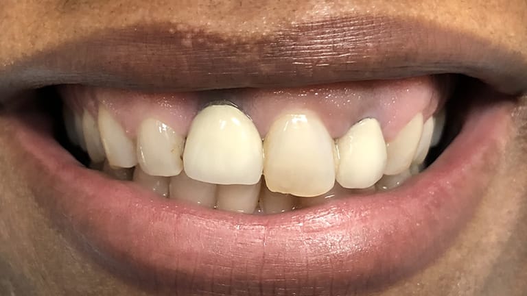 Before Crown Zirconia Benefits