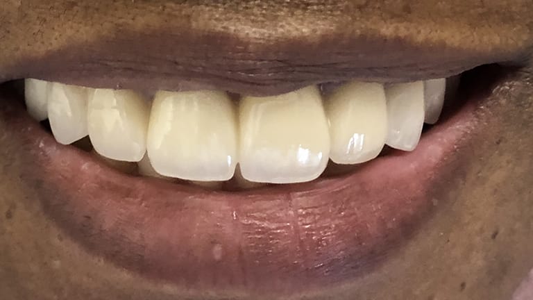 After Life-Like Crown Benefits