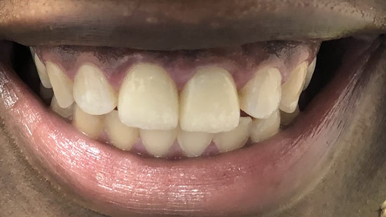 After Life-Like Crown Benefits