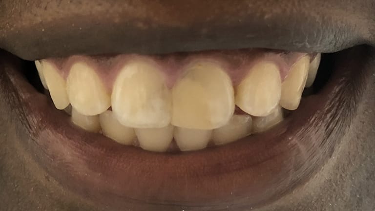 Before Life-Like Crown Benefits