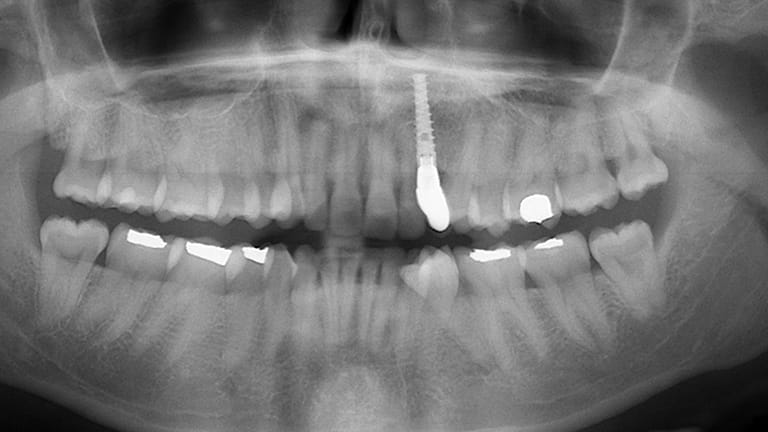 Before Dental Implant Benefits